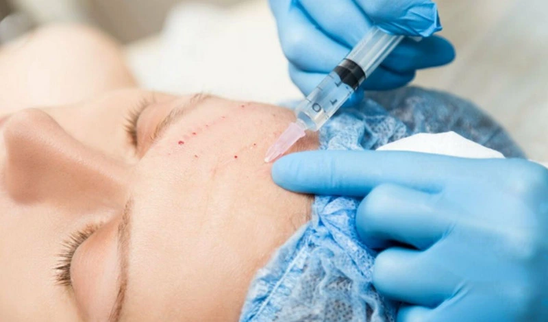 Công nghệ tiêm meso trẻ hóa (Ảnh: Phòng Khám Thẩm Mỹ MP KOREA)